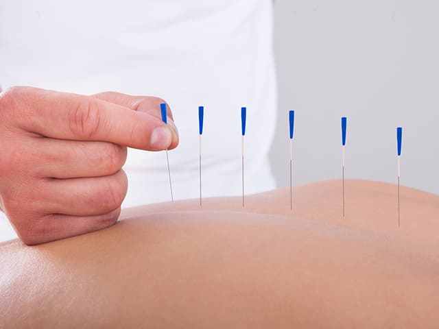 ACUPUNTURA